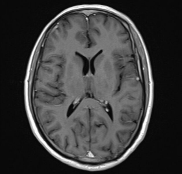 File:Cerebral venous thrombosis (Radiopaedia 71207-81504 Axial T1 C+ 14).jpg