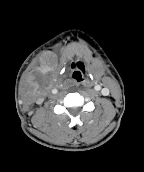 File:Cervical abscess (Radiopaedia 43725-47184 A 37).png