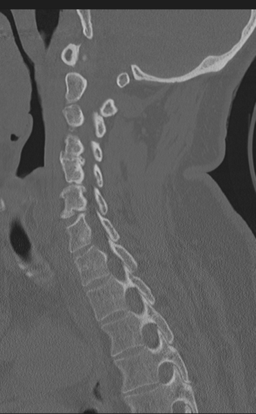 File:Cervical canal stenosis due to ossification of the posterior longitudinal ligament (Radiopaedia 47260-51823 Sagittal bone window 31).png