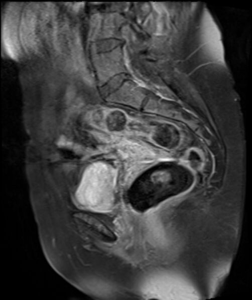 File:Cervical carcinoma (Radiopaedia 88312-104943 E 14).jpg