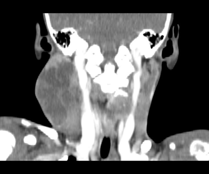 File:Cervical cystic lymphangioma (Radiopaedia 63655-72332 Coronal + contrast 23).jpg