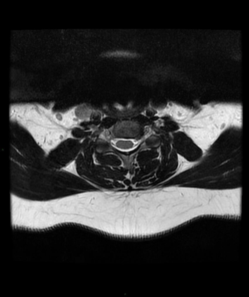 Cervical disc prolapse (Radiopaedia 80258-93598 Axial T2 37).jpg