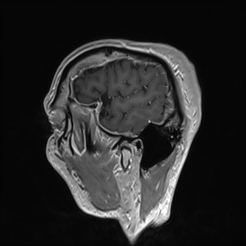 Cervical dural CSF leak on MRI and CT treated by blood patch (Radiopaedia 49748-54995 G 1).jpg