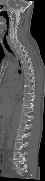 File:Cervical dural CSF leak on MRI and CT treated by blood patch (Radiopaedia 49748-54996 A 3).png