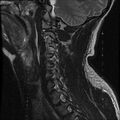 Cervical flexion teardrop fracture with cord hemorrhage (Radiopaedia 32497-33455 Sagittal T2 4).jpg