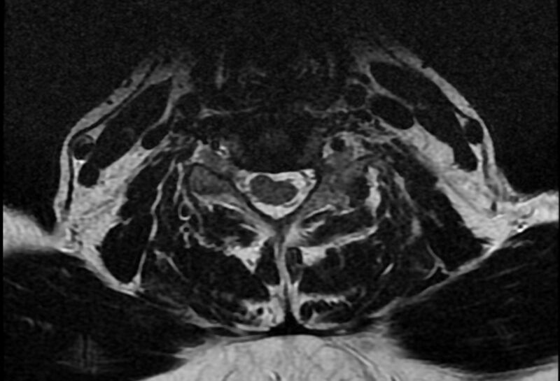 File:Cervical schwannoma (Radiopaedia 72399-82934 Axial T2 15).jpg