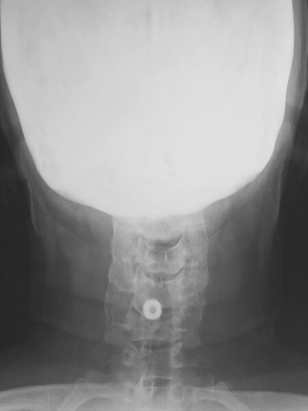 File:Cervical spine disc spacer (Radiopaedia 49612-54808 B 1).JPG