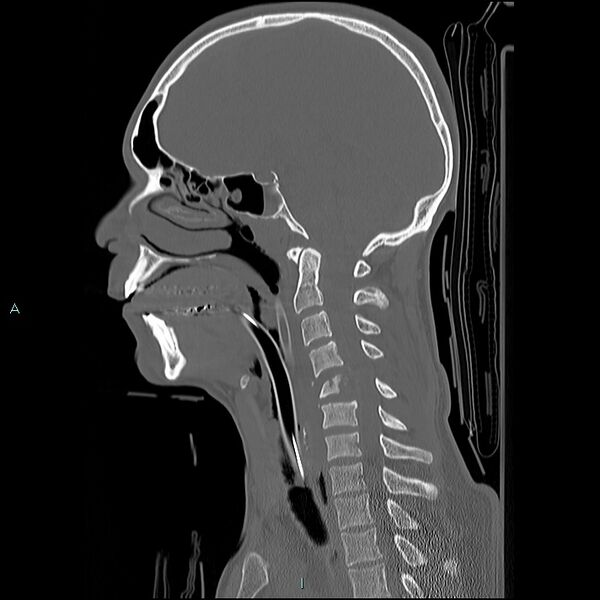 File:Cervical vertebral burst fracture (Radiopaedia 37420-39258 Sagittal bone window 14).jpg