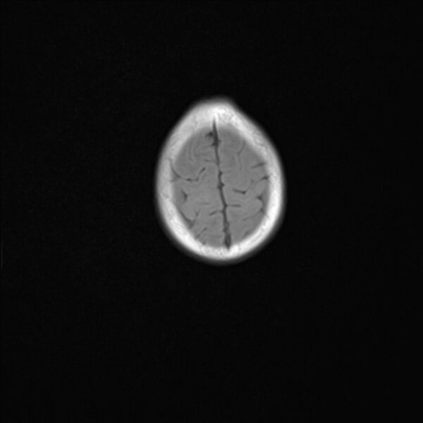 File:Chiari III malformation with occipital encephalocele (Radiopaedia 79446-92559 Axial T1 23).jpg