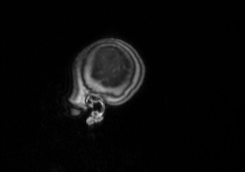 Chiari III malformation with occipital encephalocele (Radiopaedia 79446-92559 Sagittal T1 C+ mpr 60).jpg