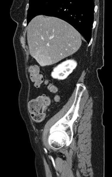 File:Cholecystoduodenal fistula due to calculous cholecystitis with gallstone migration (Radiopaedia 86875-103077 C 48).jpg