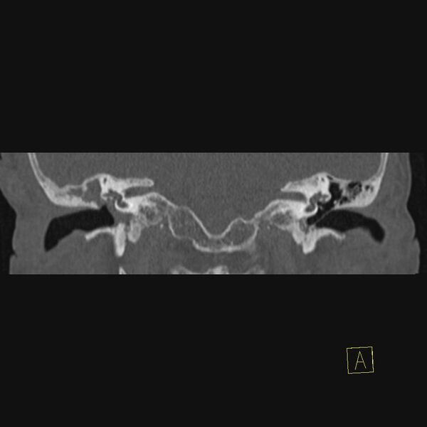 File:Cholesteatomatous chronic otitis (Radiopaedia 14993-14911 Coronal bone window 9).JPEG