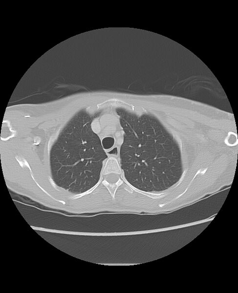 File:Chondrosarcoma (Radiopaedia 79427-92532 Axial lung window 13).jpg