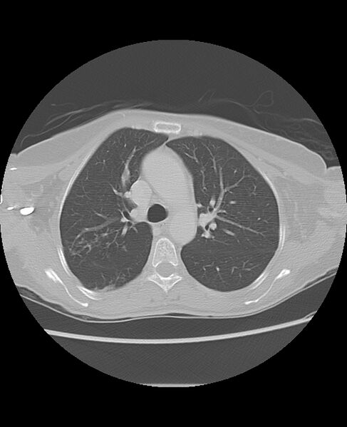 File:Chondrosarcoma (Radiopaedia 79427-92532 Axial lung window 20).jpg