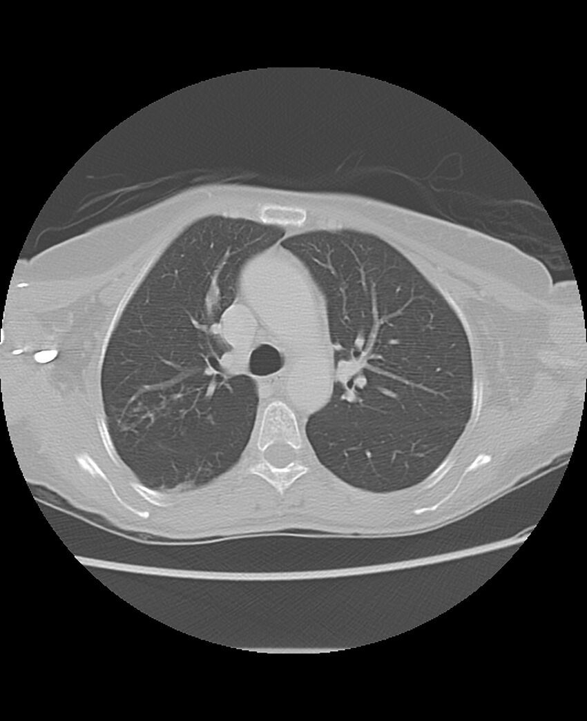 Chondrosarcoma (Radiopaedia 79427-92532 Axial lung window 20).jpg