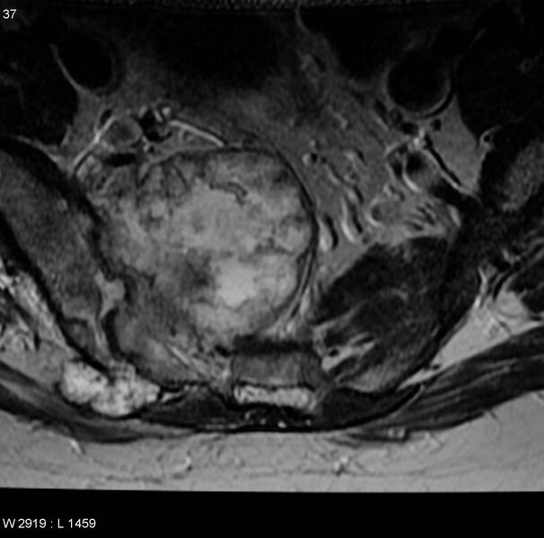 File:Chondrosarcoma - sacrum (Radiopaedia 6173-7627 Axial T2 1).jpg