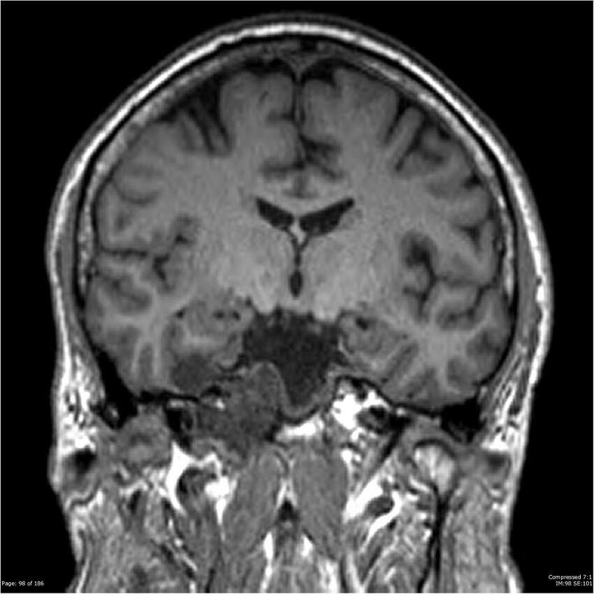 Chondrosarcoma of skull base- grade II (Radiopaedia 40948-43654 Coronal T1 19).jpg