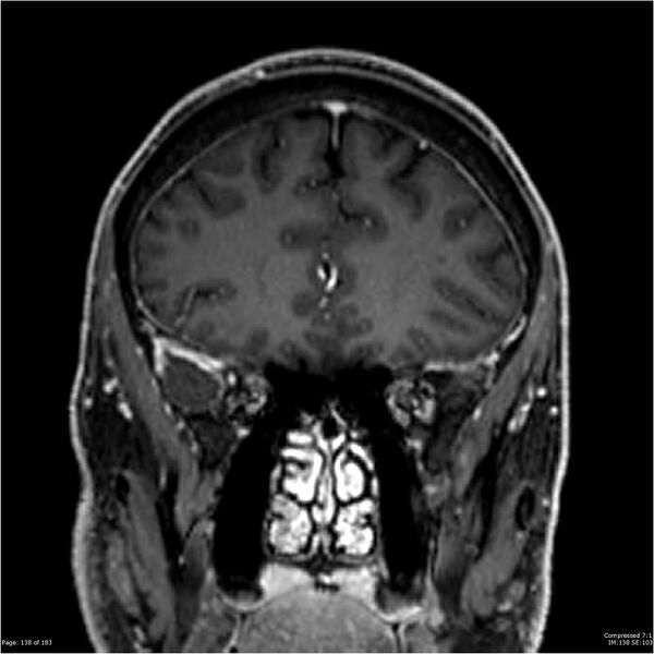 File:Chondrosarcoma of skull base- grade II (Radiopaedia 40948-43654 Coronal T1 C+ 49).jpg