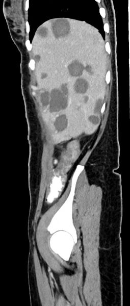 File:Choriocarcinoma liver metastases (Radiopaedia 74768-85766 C 140).jpg