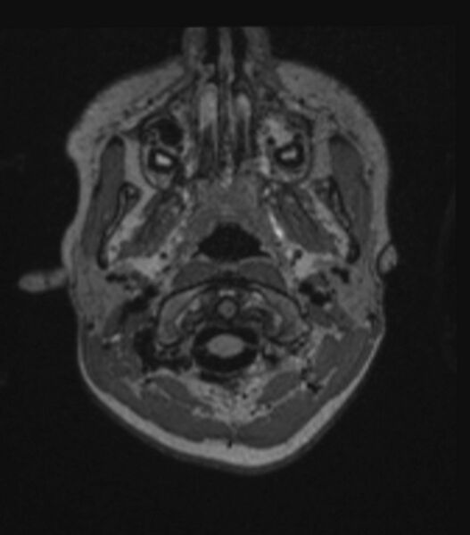 File:Choroid plexus carcinoma (Radiopaedia 91013-108553 Axial FLAIR C+ 63).jpg