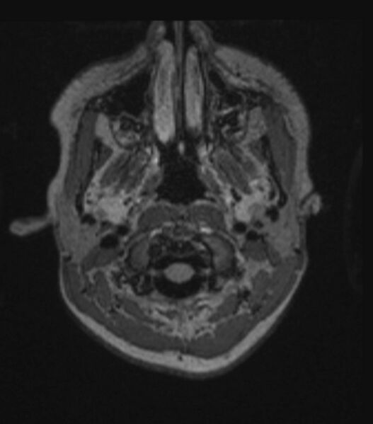 File:Choroid plexus carcinoma (Radiopaedia 91013-108553 Axial FLAIR C+ 66).jpg