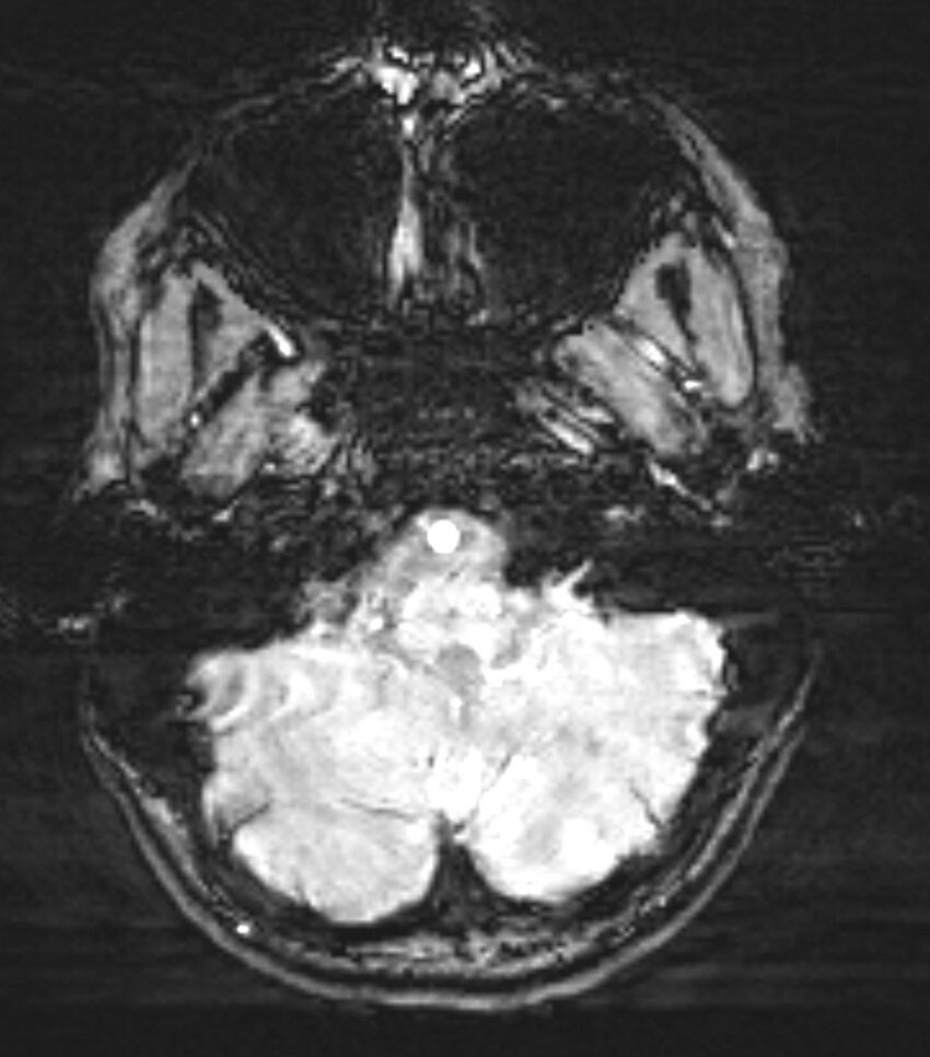 Choroid plexus carcinoma (Radiopaedia 91013-108553 Axial SWI 17).jpg
