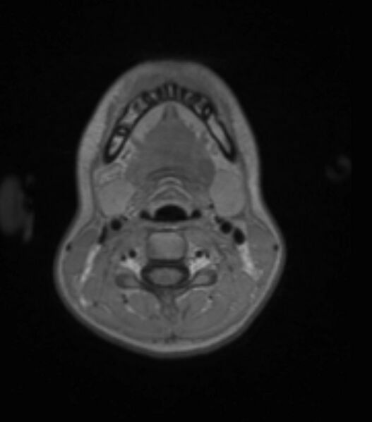 File:Choroid plexus carcinoma (Radiopaedia 91013-108553 Axial T1 C+ 21).jpg