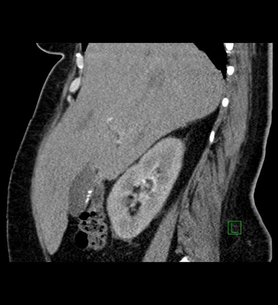 File:Chromophobe renal cell carcinoma (Radiopaedia 84239-99519 D 81).jpg