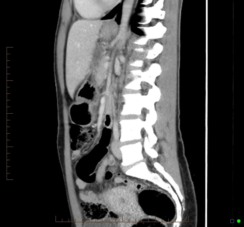 Chronic abscess due to "dropped" appendicoliths following appendectomy for perforated appendix (Radiopaedia 58805-66344 D 26).jpg