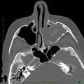 Chronic invasive fungal sinusitis with mycetoma (Radiopaedia 27430-27626 Axial bone window 1).jpg