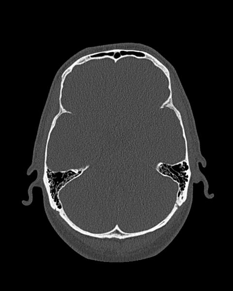 File:Chronic maxillary sinusitis caused by a foreign body (Radiopaedia 58521-65676 Axial bone window 289).jpg