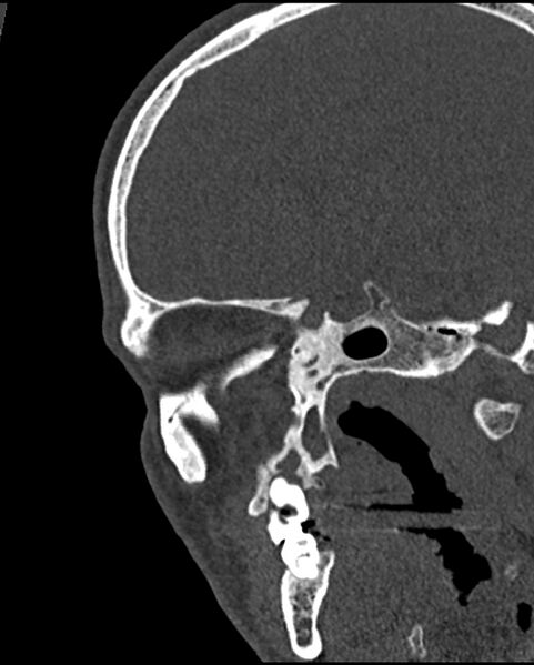 File:Chronic maxillary sinusitis caused by a foreign body (Radiopaedia 58521-65676 Sagittal bone window 55).jpg