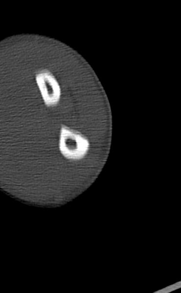 File:Chronic osteomyelitis of the distal humerus (Radiopaedia 78351-90971 Axial bone window 122).jpg