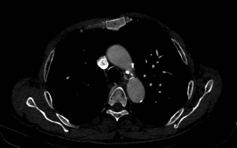 File:Chronic pulmonary embolism (Radiopaedia 91241-108843 B 59).jpg