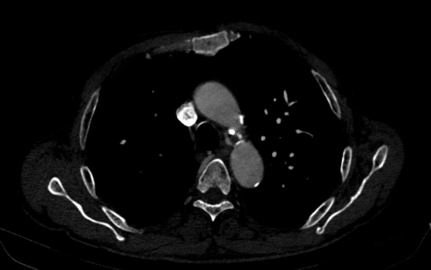 Chronic pulmonary embolism (Radiopaedia 91241-108843 B 59).jpg
