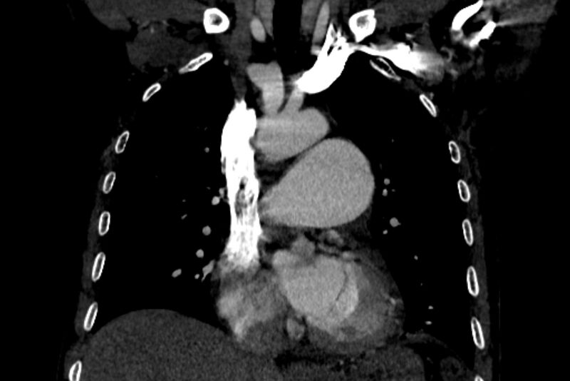 File:Chronic pulmonary embolism with bubbly consolidation (Radiopaedia 91248-108850 B 62).jpg