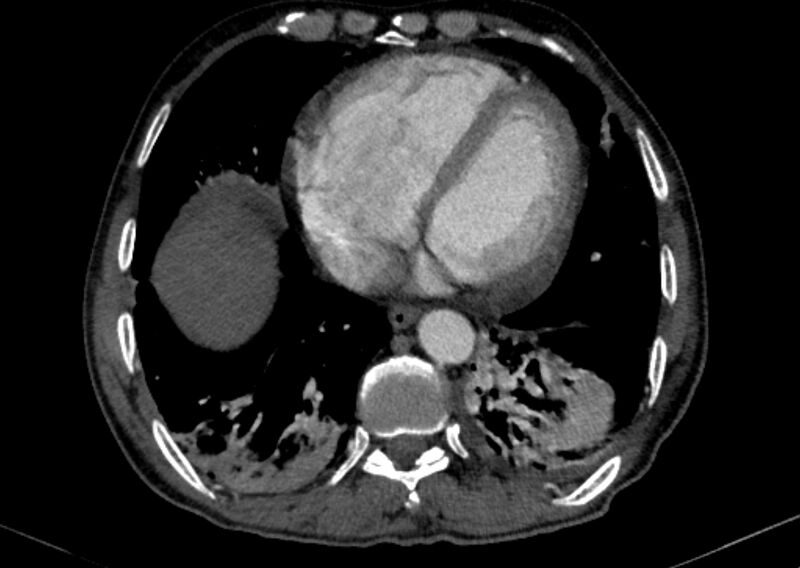 File:Chronic pulmonary embolism with bubbly consolidation (Radiopaedia 91248-108850 C+ arterial phase 111).jpg