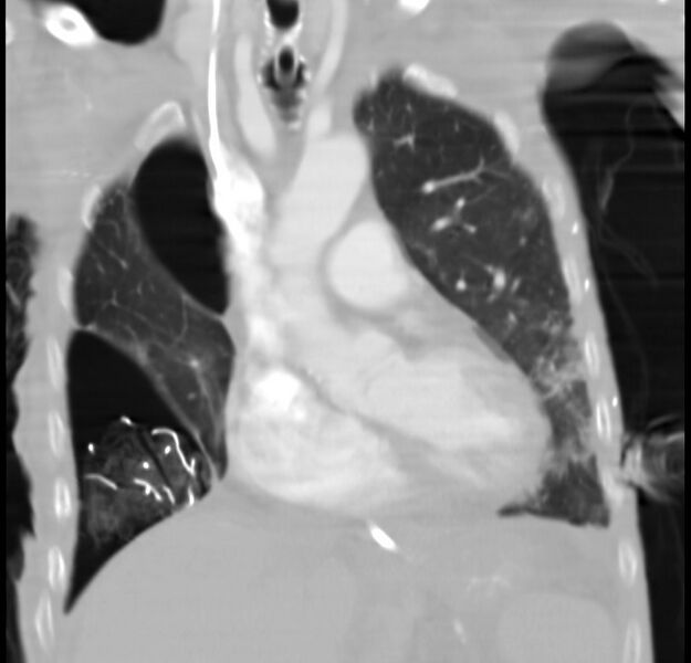 File:Clagett thoracotomy with bronchopleural fistula (Radiopaedia 29192-29587 Coronal lung window 20).jpg