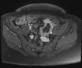 Class II Mullerian duct anomaly- unicornuate uterus with rudimentary horn and non-communicating cavity (Radiopaedia 39441-41755 Axial T1 fat sat 23).jpg