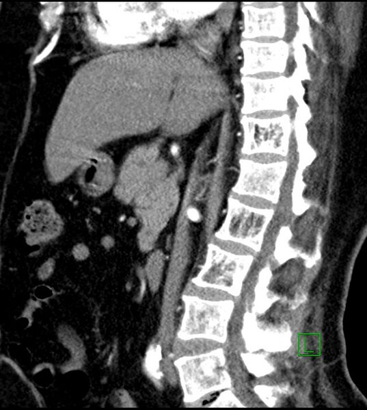 File:Clear cell renal cell carcinoma (Radiopaedia 85004-100537 D 33).jpg