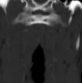 Cleft of the posterior arch of C1 mimicking fracture (Radiopaedia 40201-42721 Coronal bone window 17).jpg