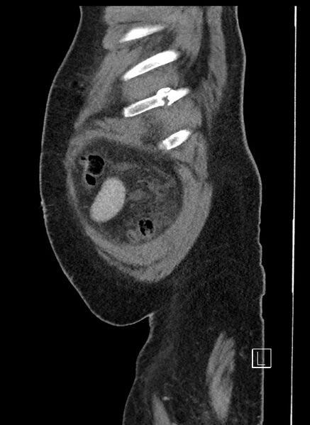 File:Closed loop obstruction - internal hernia into nephrectomy bed (Radiopaedia 59867-67320 C 104).jpg