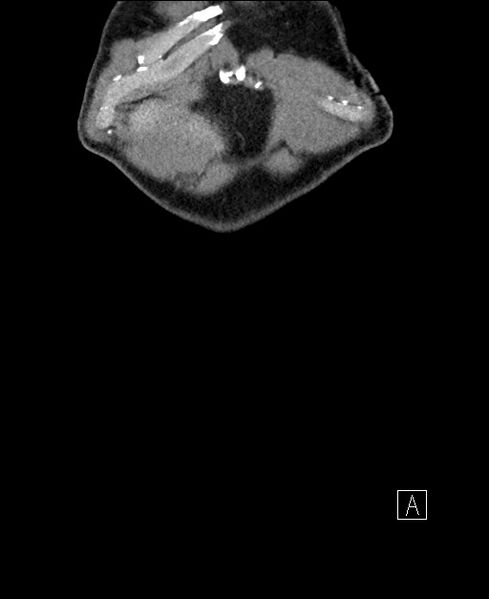 File:Closed loop small bowel obstruction - internal hernia (Radiopaedia 57806-64778 A 3).jpg