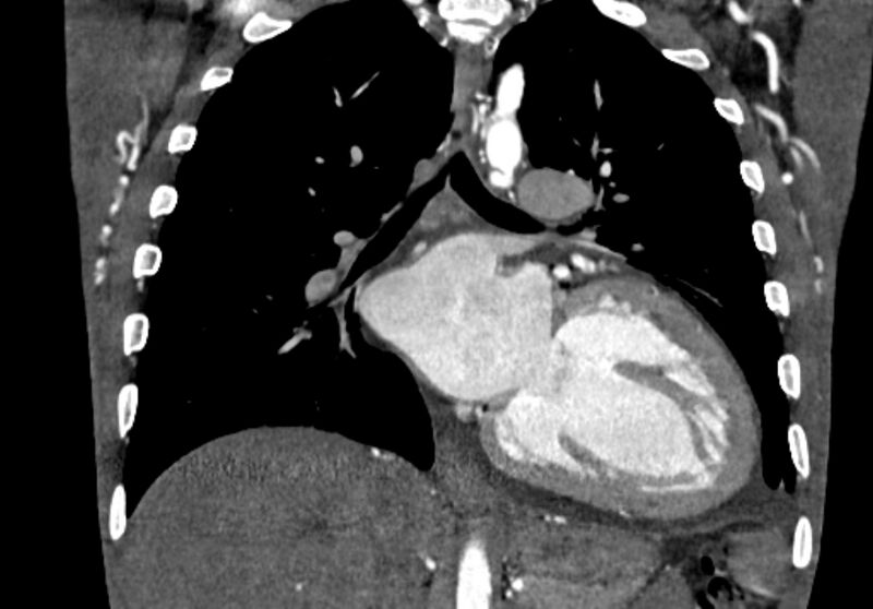 File:Coarctation of aorta with aortic valve stenosis (Radiopaedia 70463-80574 C 137).jpg