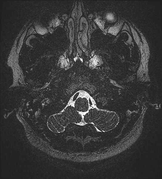 File:Cochlear incomplete partition type III associated with hypothalamic hamartoma (Radiopaedia 88756-105498 Axial T2 18).jpg