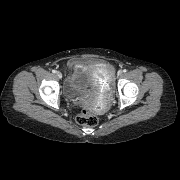 File:Cocoon abdomen with possible tubo-ovarian abscess (Radiopaedia 46235-50636 A 40).png