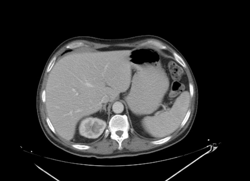 File:Colon cancer mimicking renal cell carcinoma (Radiopaedia 28986-29335 C 14).jpg