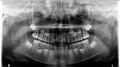 Dental agenesis (Radiopaedia 83969).jpg