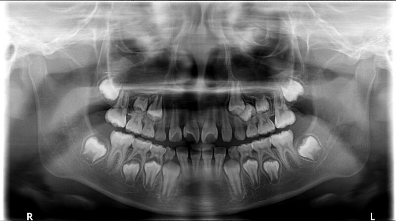 File:Dental agenesis (Radiopaedia 83969).jpg