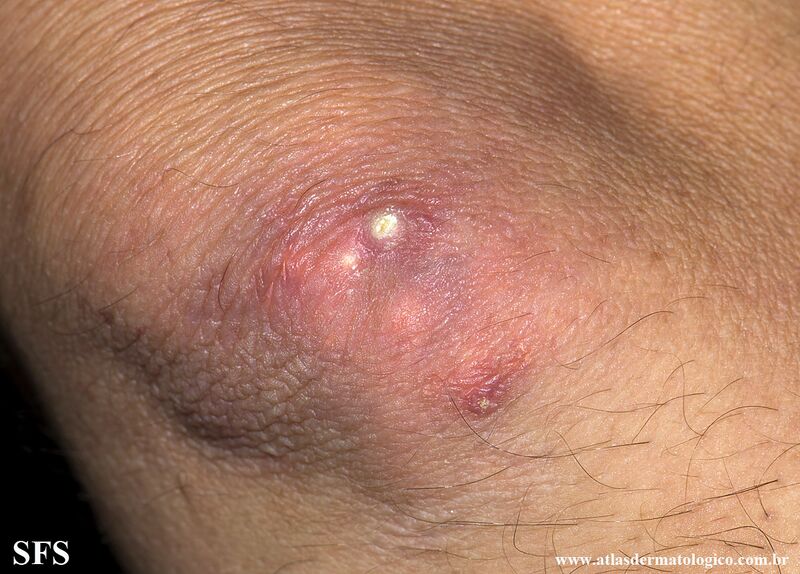 File:Gout (Dermatology Atlas 12).jpg